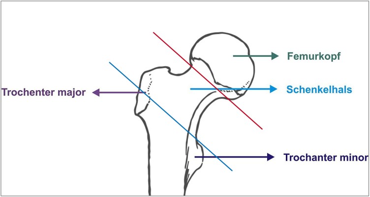 Schematisch Darstellung von Formen der hüftgelenknahen Femurfraktur
