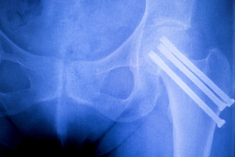 Röntgenbild einer Drei-Schrauben-Osteosynthese